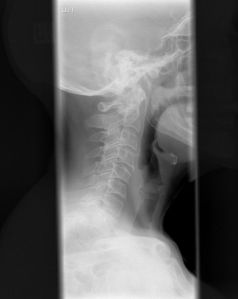 cervical spine x-ray 